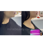 Lipo One V-Line PPC 溶脂 10x10ml